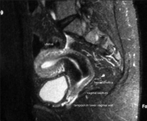 The MRI Shows Uterus With Cervix And Upper Cm Of Vagi Open I