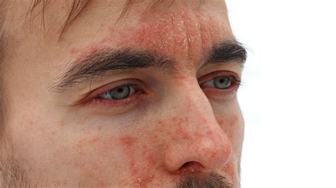 Psoriasis On The Face Symptoms Types Treatment And More