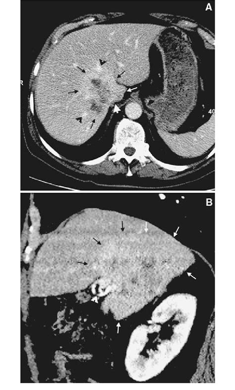 Contrast Enhanced Ct Showing A Contrast Enhancing Lesion With 10 Cm In