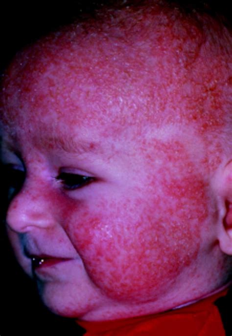 Childhood Atopic Eczema The Bmj