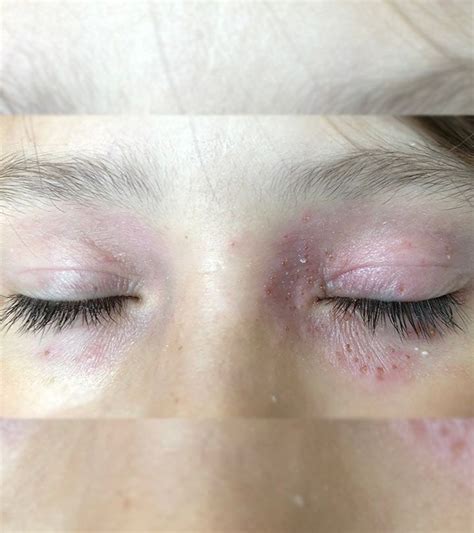 Rashes Around The Eyes Can Occur Due To Allergies Or Inflammation The
