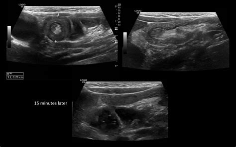 Intussusception Target Sign