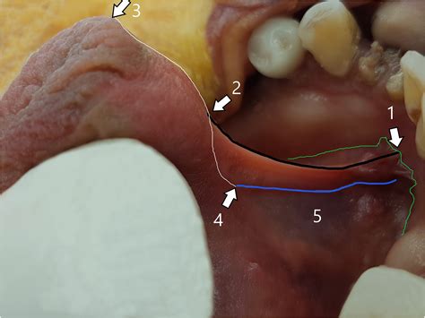 What Is A Tongue Tie Defining The Anatomy Of The In‐situ Lingual Frenulum Mills 2019
