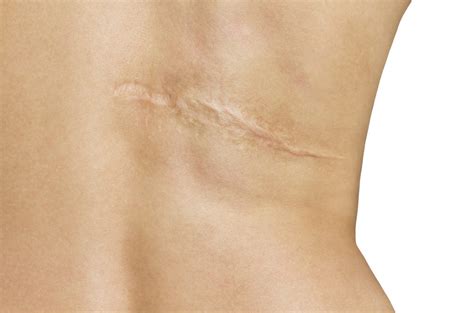 Scar Removal Treatment U S Dermatology Partners