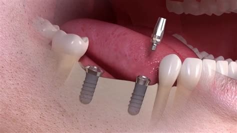 Straumann Implants To Replace Multiple Teeth Youtube