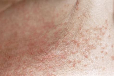 Heat Rash Signs Duration And Treatment