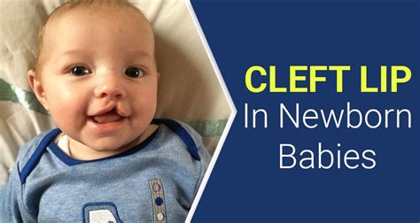 Everything You Need To Know About Cleft Lip In Babies