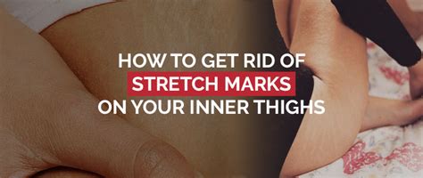 4 Ways To Get Rid Of Stretch Marks On Your Inner Thigh Fast