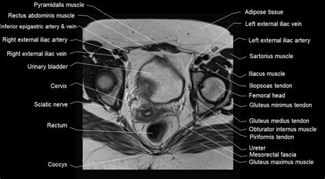 Mri Female Pelvis Anatomy Axial Image 19 Pelvis Anatomy Rectus Abdominis Muscle Gluteus Medius