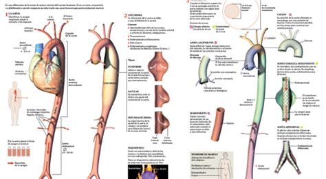 Aneurismas De Aorta Tipos Síntomas Y Tratamiento Clínica Universidad