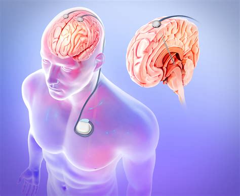 Deep Brain Stimulation Pictures