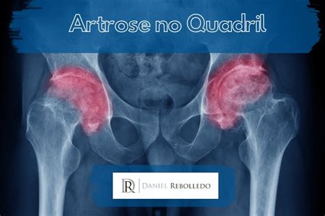 Artrose De Quadril Osteoartrose Dr Daniel Rebolledo