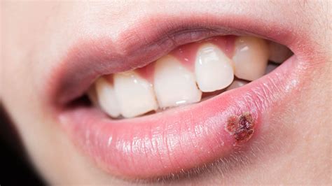 Herpes Labial Síntomas Y Causas Grup Dr Bladé