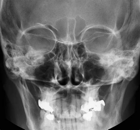 Flashcards Skull Cranium Sinuses And Nasal How Many
