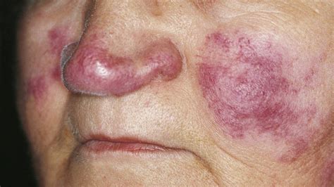 Lupus Eritematoso Qué Es Síntomas Causas Y Tratamiento