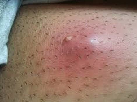 A lump in your underarm feels like a swelling inside the skin. Ingrown Hair cyst, Get Rid, Large, Deep, Pictures
