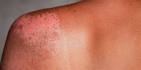 Common Summer Skin Rashes Consumer Health News Healthday