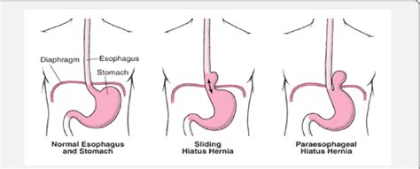 Figure 2 From Congenital Diaphragmatic Hernias A Review Article