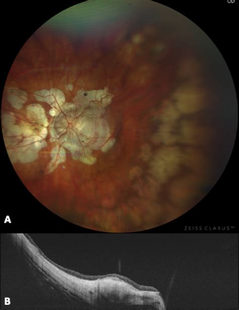 Posterior Staphyloma As Determining Factor For Myopic Maculopathy