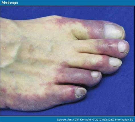 Blue Toe Syndrome Loss Of Blood Flow Due To Constricted Vessels This