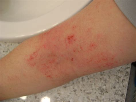 Forearm Rashes Pictures Photos