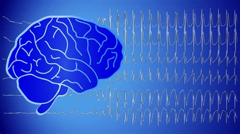Epilepsie Sieben Von Zehn Patienten Könnten Ohne Anfälle Leben Kurierat