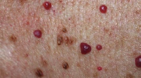 Raised Skin Bump 25 Causes Photos And Treatments Su Oggi
