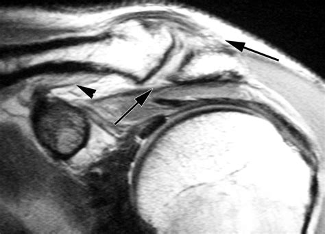 Mr Imaging Appearances Of Acromioclavicular Joint Dislocation