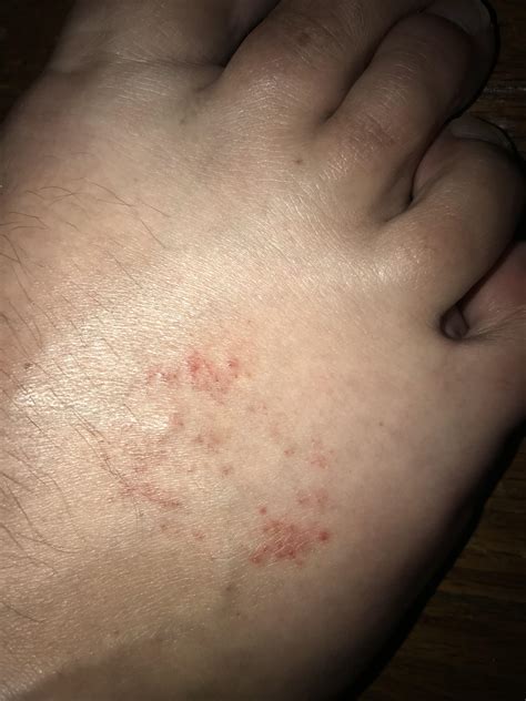 Rash On Top Of Foot Raised Small Red Bumps Not Itchy Or Painful
