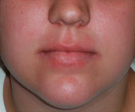 Allergic Contact Dermatitis Of The Lips Due To Allergy To Lanolin In