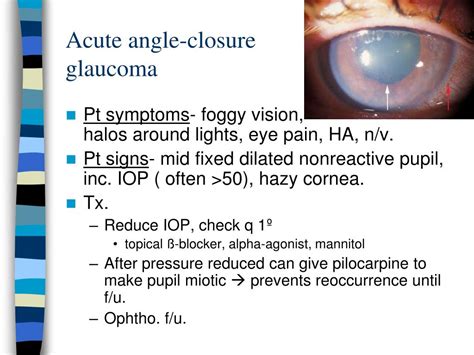 Obstructed aqueous outflow tract → aqueous humor builds up → increased intraocular pressure (iop) → optic nerve damage → vision loss. PPT - Ocular emergencies PowerPoint Presentation - ID:764166