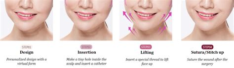Thread Lifting Procedure Complete Guide To Thread Face Lift Seoul