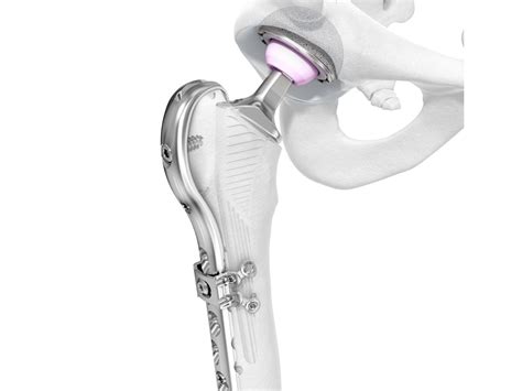 Hip And Femur Fracture Solutions Depuy Synthes Jandj Medtech