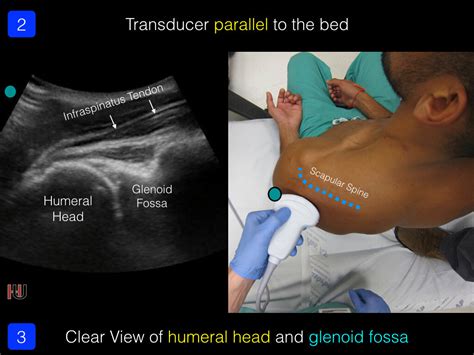 Arthrocentesis Shoulder — Highland Em Ultrasound Fueled Pain Management