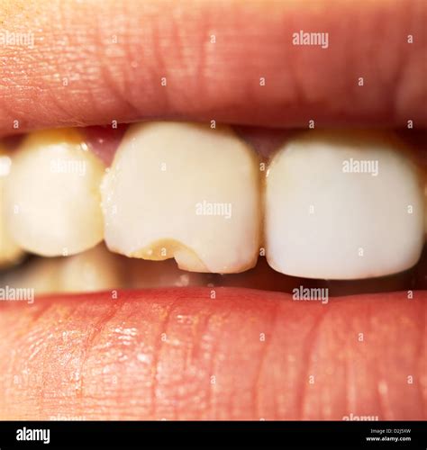 Rotten Teeth Stock Photos & Rotten Teeth Stock Images - Alamy