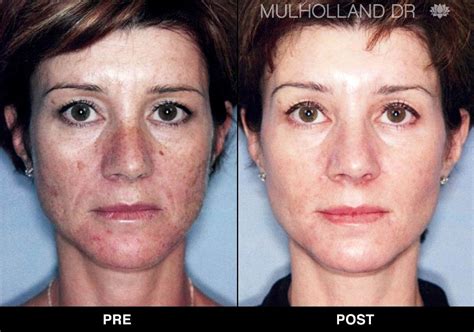 Fotofacial Ipl Before And After Photos In Toronto Spamedica Laser