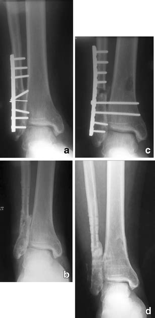 Realignment Lengthening Osteotomy For Malunited Distal Fibular Fracture