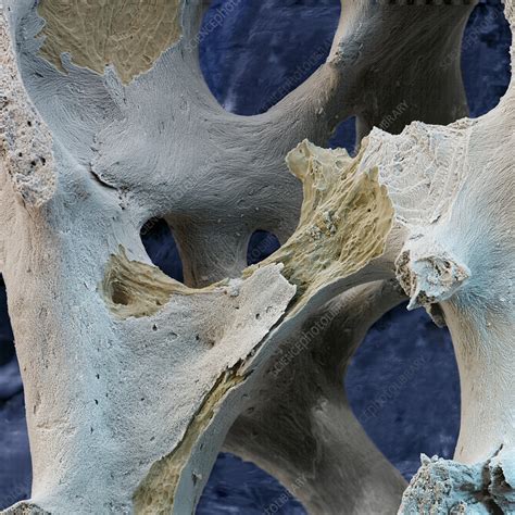 Osteoporosis Sem Stock Image M2300472 Science Photo Library