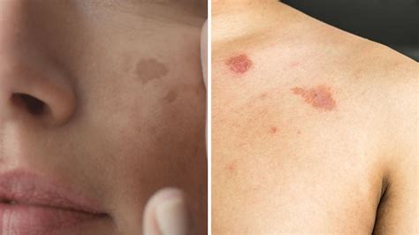 Tipos de manchas en la piel fotos qué significan y cuándo debes ir al médico