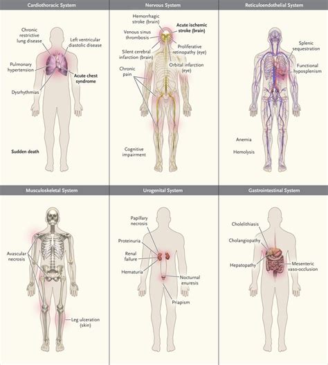 Sickle Cell Disease | NEJM