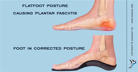 How Flatfoot Posture Cause Plantar Fasciitis Mass4d Foot Orthotics