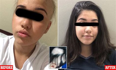 Pictures Show Transformation Of 13 Year Old With Alopecia After Being