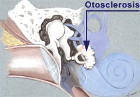 Otosclerosis Risk Factors Diagnosis And Treatments