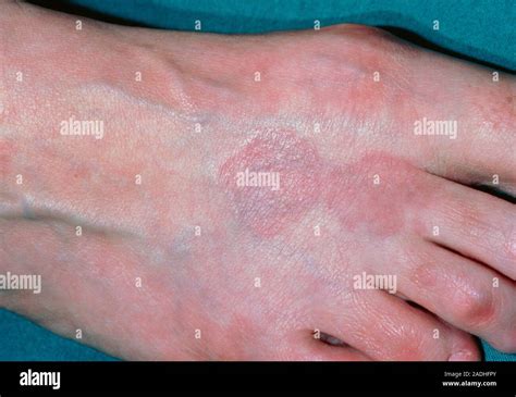 Skin Disorder Foot Affected By Granuloma Annulare It Is An Harmless