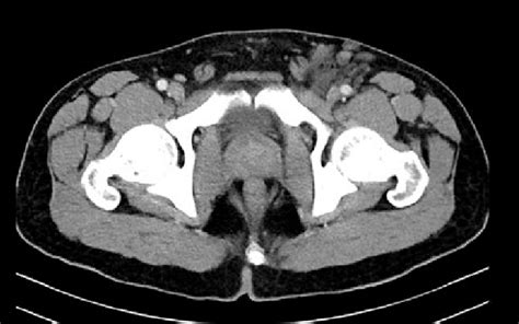 Axial Postcontrast Computed Tomography Scan Image Showing Multiple
