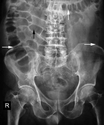 Generalized abdominal pain for 24 hours and more recent onset of vomiting. Abdominal X-ray Interpretation (AXR) | Radiology | OSCE ...