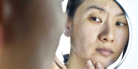 How To Get Rid Of Acne Holes On Face Professional Treatments And Cost