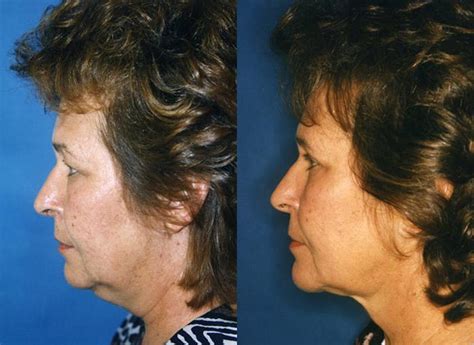 Patient 122406503 Laser Assisted Weekend Neck Lift Before And After