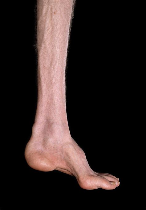 Charcot Marie Tooth Disease Photograph By Science Photo Library