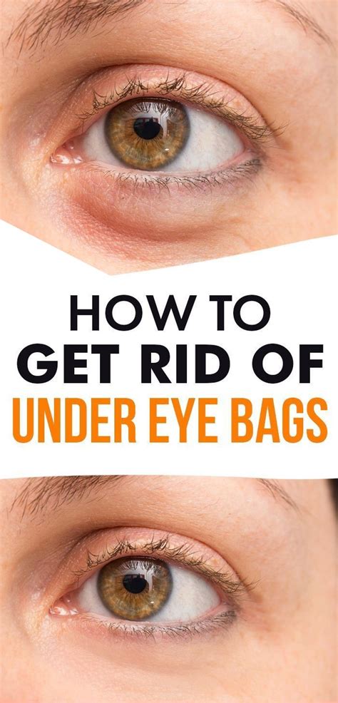 How To Get Rid Of Bags Under Eyes 16 Home Remedies Prevention Tips Healthy Lifestyle